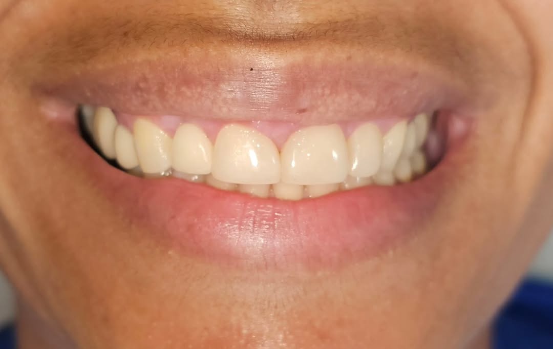 Mesmo sorriso depois das facetas, com forma e cor harmonizadas