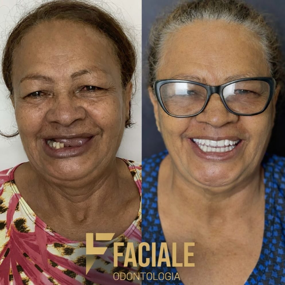 A mesma paciente sorrindo depois da reabilitação oral concluída